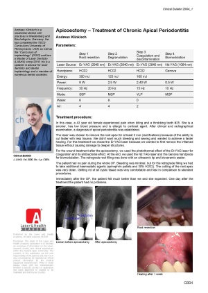 Apicoectomy – Treatment of Chronic Apical Periodontitis