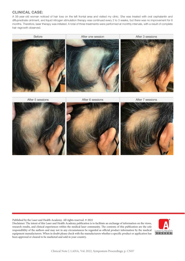 Treatment of Alopecia Areata with HAIRestart®