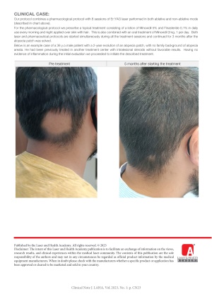 Combined laser and pharmacological treatment of Alopecia Areata