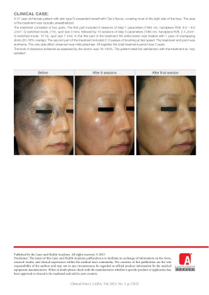 Two-Part Treatment of Ota’s Nevus