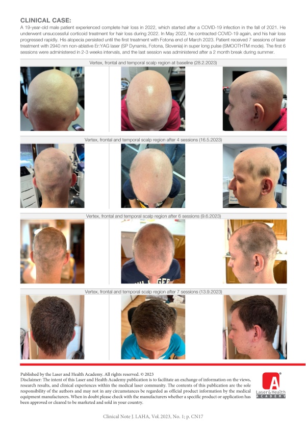 Alopecia Totalis treated with HAIRestart®