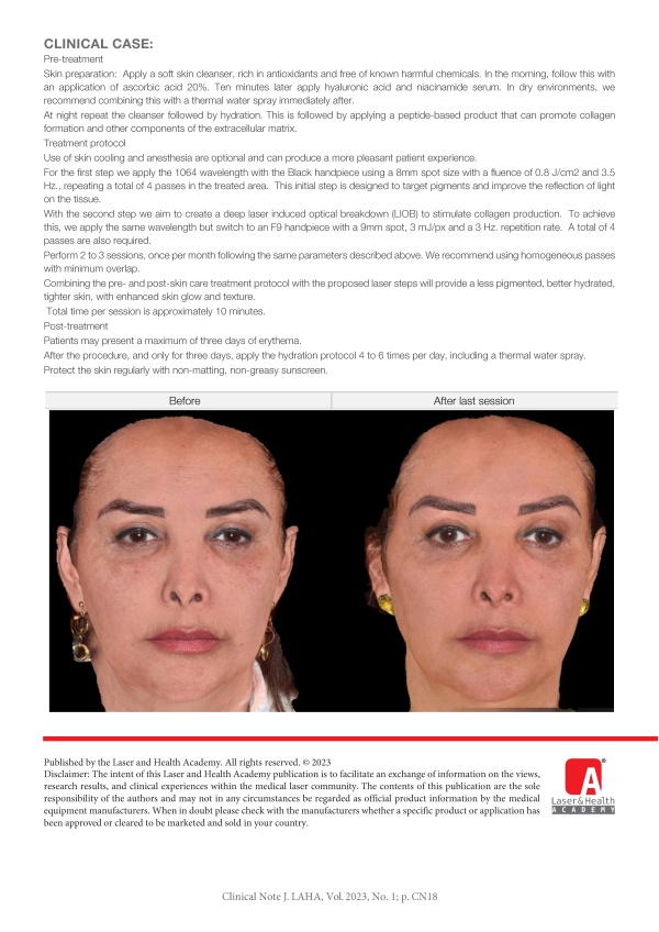 Fotona Skin Glow treatment with StarWalker® PQX pico laser