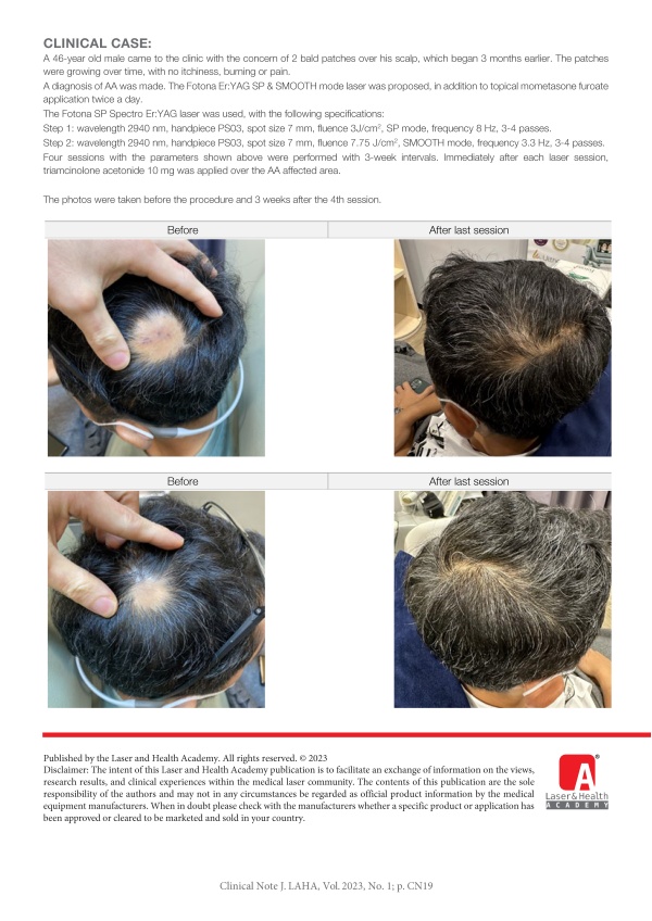 Enhanced Drug Transportation for Treatment of Alopecia Areata