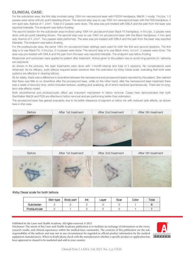 Picosecond and Nanosecond Laser for Tattoo Removal