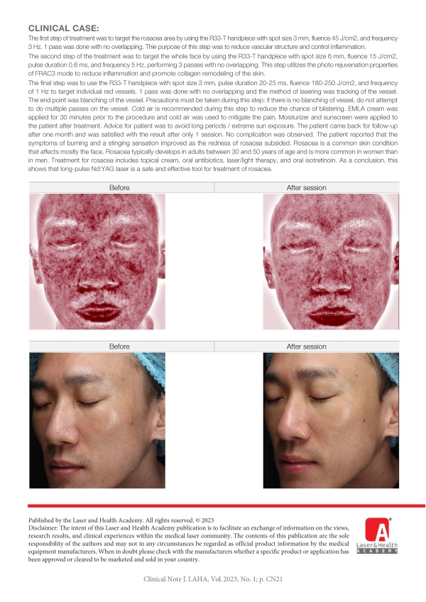 Single Session of Long-Pulse Nd:YAG Laser for Treatment of Facial Rosacea