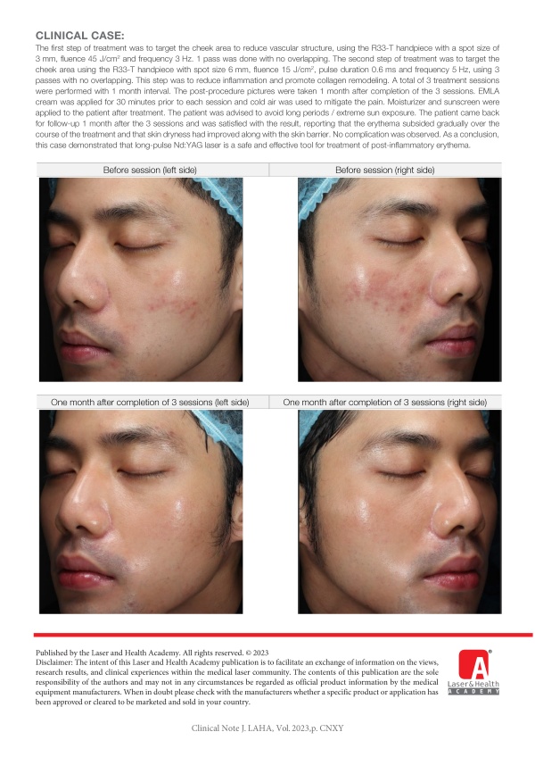 Treatment for Prolonged Erythema from Chemical Peeling with Long-pulse Nd:YAG Laser