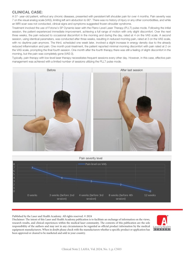 Photobiomodulation and Pain Management (ComfortLase™) using PLLT for Treatment of Shoulder Pain