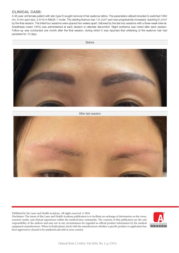 Eyebrow Tattoo Removal