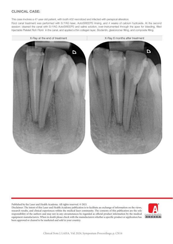Regenerative Endodontic Treatment of Mature, Necrotized, Infected Teeth with Er:YAG Laser 