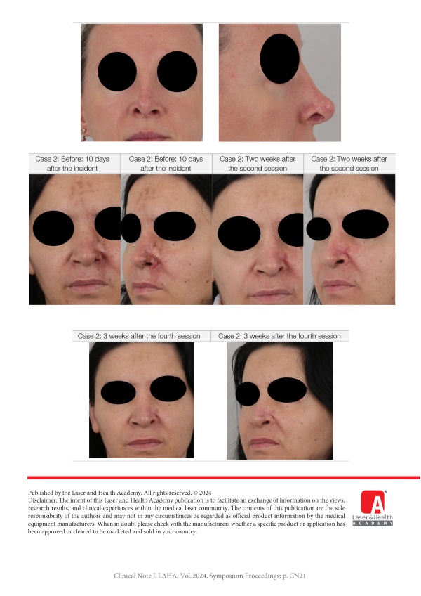 Treatment of Hyaluronic Acid Filler Complication: Nasal Skin Necrosis