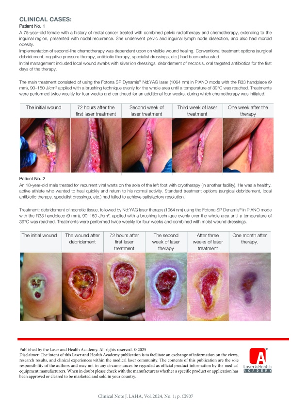 Hard-to-Heal Wounds – an Avoidable Problem: Lasers in the treatment of difficult-to-heal wounds