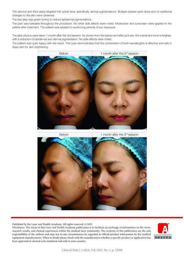 Toning of Asian Skin with Dual Wavelength Picosecond Laser