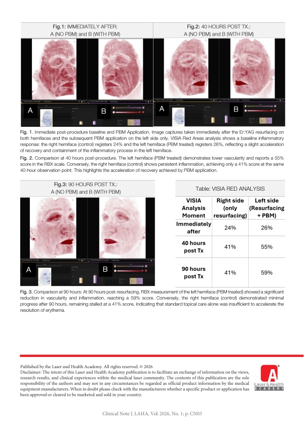 Accelerated Facial Recovery after Er:YAG Resurfacing Using Immediate PBM with 1064 nm Nd:YAG