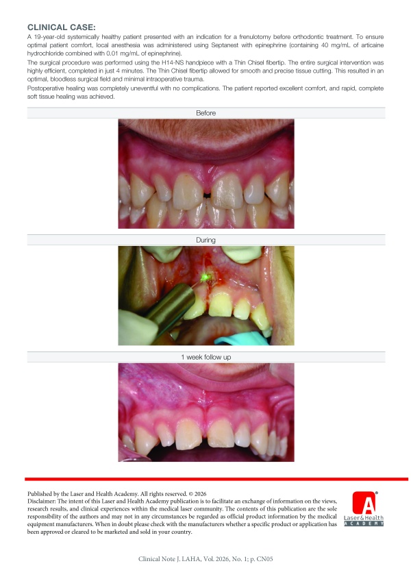 Frenulotomy using the H14-NS handpiece with the Thin Chisel fibertip