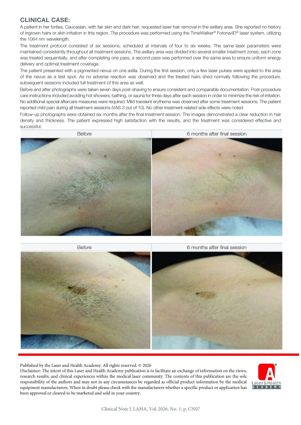 Long-Pulse 1064 nm Nd:YAG Laser Hair Reduction of the Axillary Area with TimeWalker® Fotona4D®