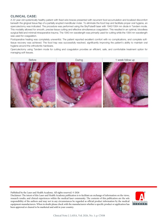 Diode Laser-Assisted Operculectomy Using a 1064/1940 nm tandem mode