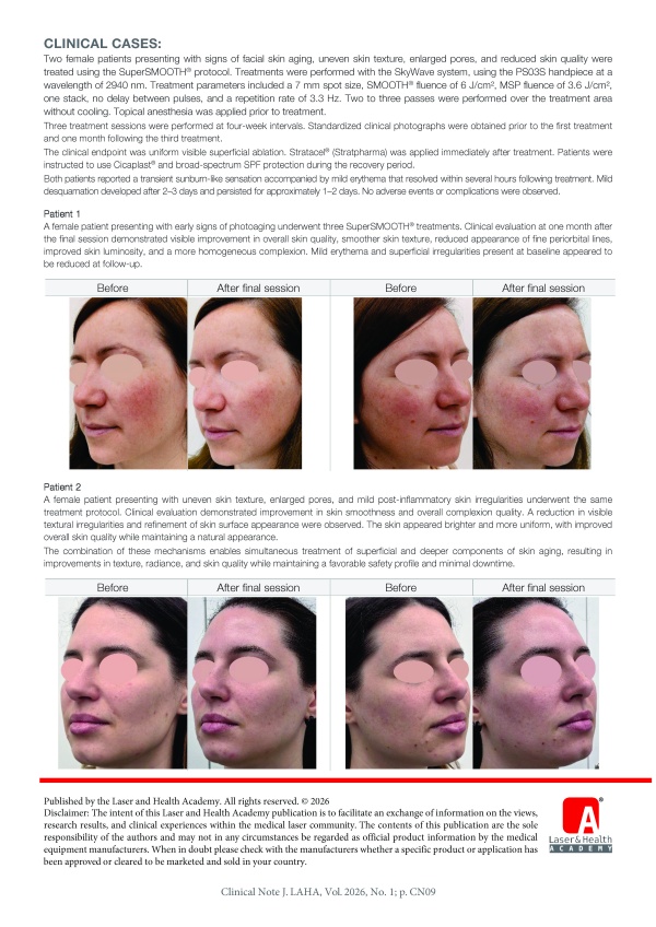 SuperSMOOTH® Skin Rejuvenation Using the Fotona SkyWave® 2940 nm Er:YAG Laser 