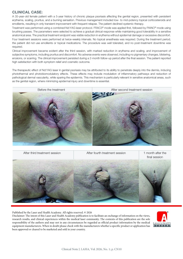 Nd:YAG Laser Therapy for Genital Psoriasis: A Case Report