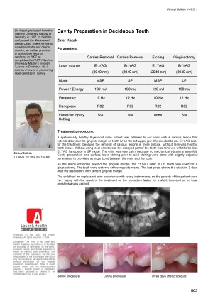 Cavity Preparation in Deciduous Teeth