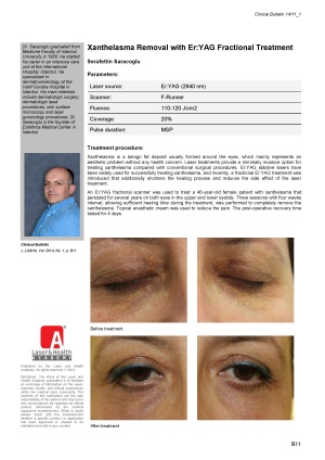 Xanthelasma Removal with Er:YAG Fractional Treatment