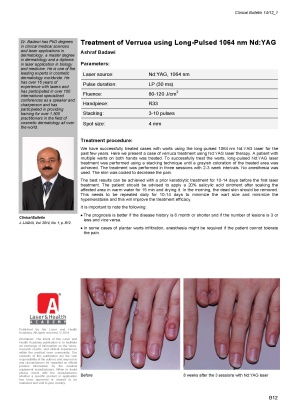 Treatment of Verruca Using Long-Pulsed 1064 nm Nd:YAG