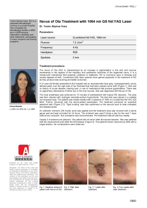 Nevus of Ota Treatment with 1064 nm QS Nd:YAG Laser