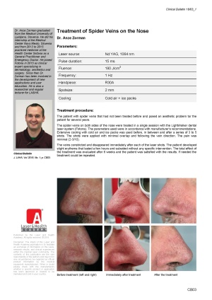 Treatment of Spider Veins on the Nose