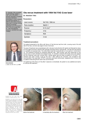 Ota nevus treatment with 1064 Nd:YAG Q-sw laser