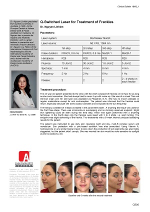 Q-Switched Laser for Treatment of Freckles