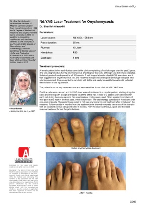 Nd:YAG Laser Treatment for Onychomycosis