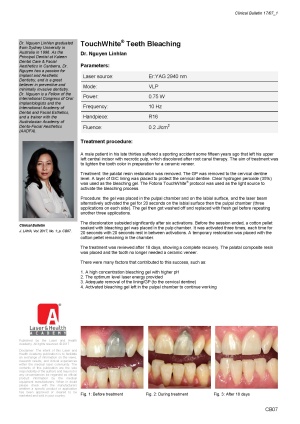 TouchWhite® Teeth Bleaching