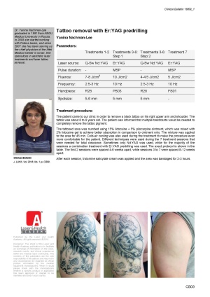 Tattoo Removal with Er:YAG Predrilling