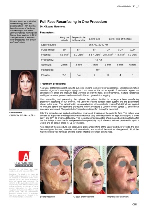 Full face resurfacing in one procedure