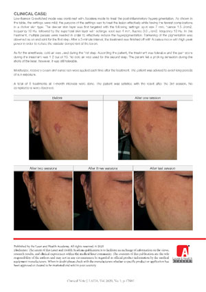 Treatment of Post-inflammatory Hyperpigmentation with a combination of QS Nd:YAG Laser and long-pulse Accelera Mode