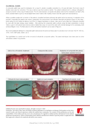 Orthodontic Composite Splint Removal