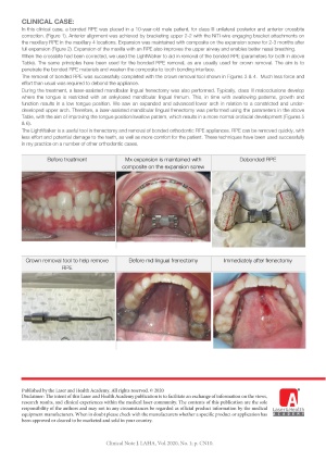 Orthodontic Crossbite Correction – Mandibular Lingual Frenectomy & Removal of a Bonded RPE