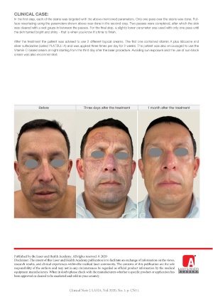 5D Rejuvenation with Pigmentation Removal