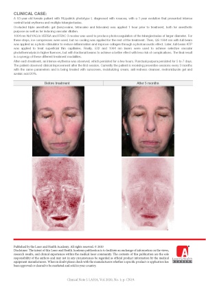 Treatment of Rosacea with a 6-step Protocol using the StarWalker MaQX Laser System