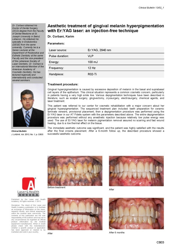 Aesthetic Treatment of Gingival Melanin Hyperpigmentation with Er:YAG Laser: An Injection-Free Technique