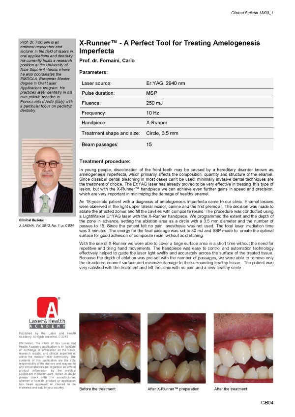 X-Runner™ - A Perfect Tool for Treating Amelogenesis Imperfecta